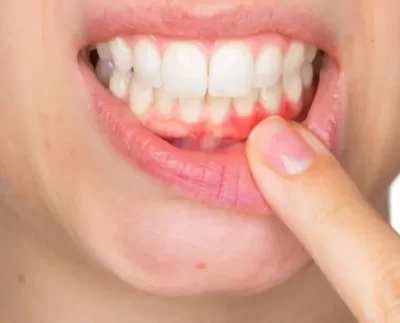 Tedavi diş