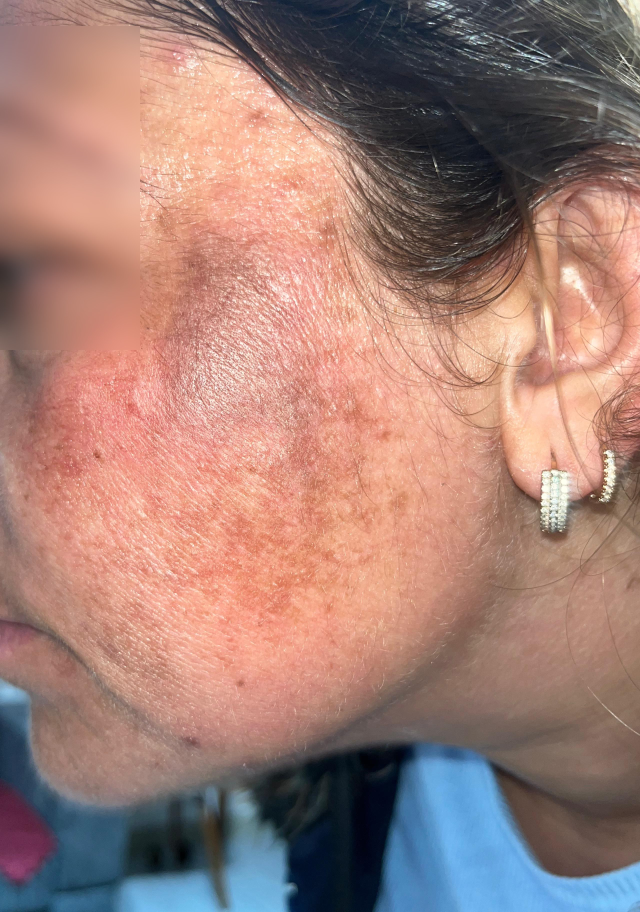 Tıbbi bir hata nedeniyle bir kadının yüzü deforme oluyor