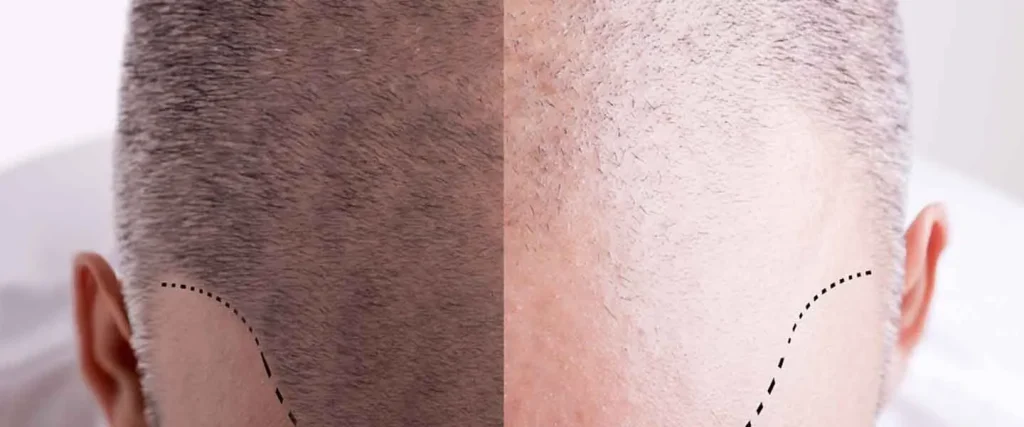 sac ekimi nasil yapilir